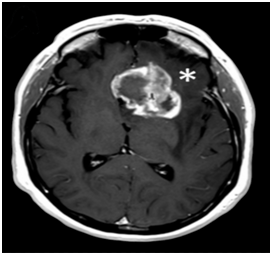 Brain Tumor Case: The Role of MRI in Early Detection