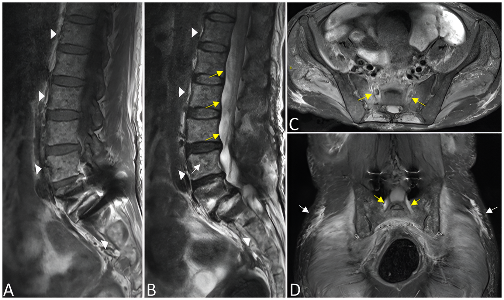 MRI Diagnoses Multiple Myeloma with Vertebral Involvement