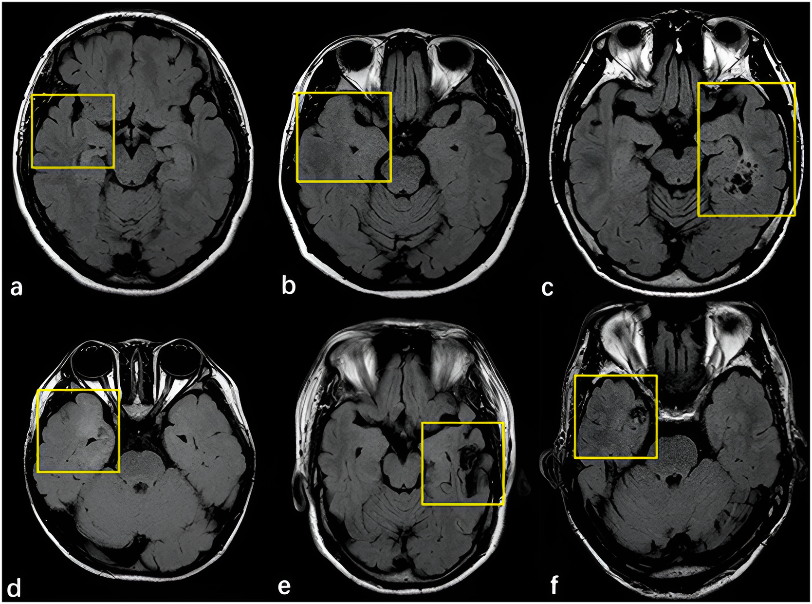 Pediatric Case: MRI for Seizure Evaluation in Children