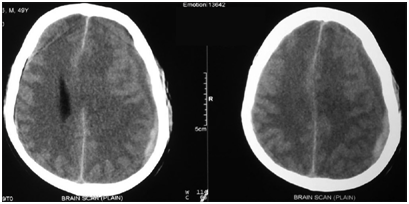 CT Brain Scan Reveals Subdural Hematoma in Elderly Fall Patient