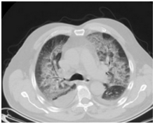 CT Chest Detects COVID-19 Pneumonia in a Symptomatic Patient