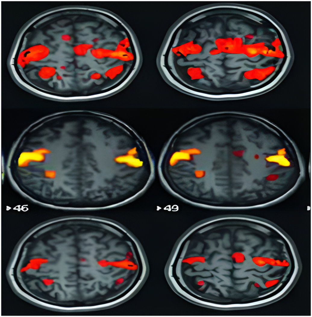 Functional MRI (fMRI): Seeing the Brain in Action
