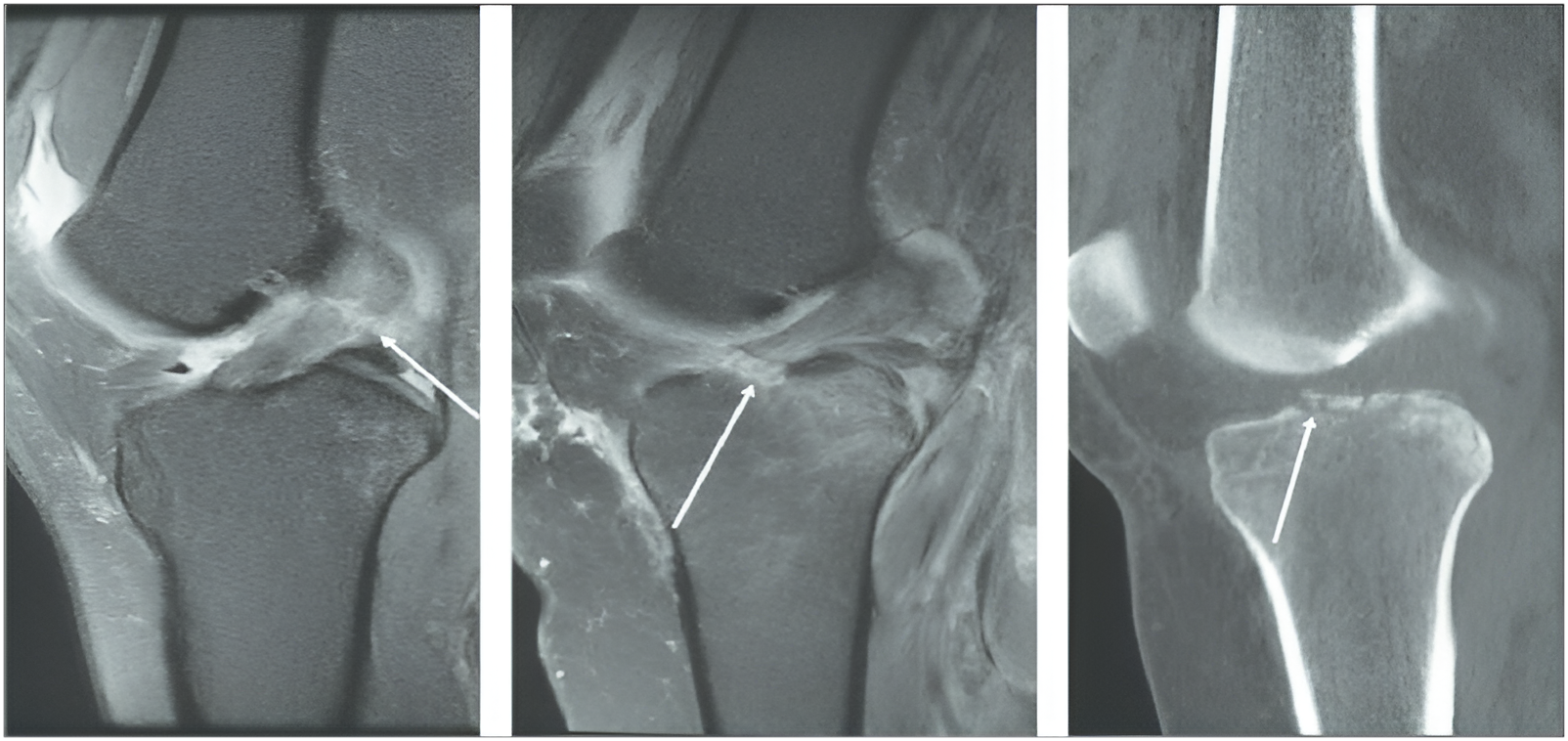 MRI Identifies ACL Tear in a Teenage Athlete