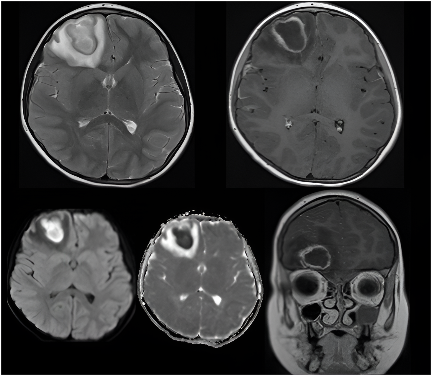 MRI Identifies Brain Abscess in a Febrile Patient with Headache