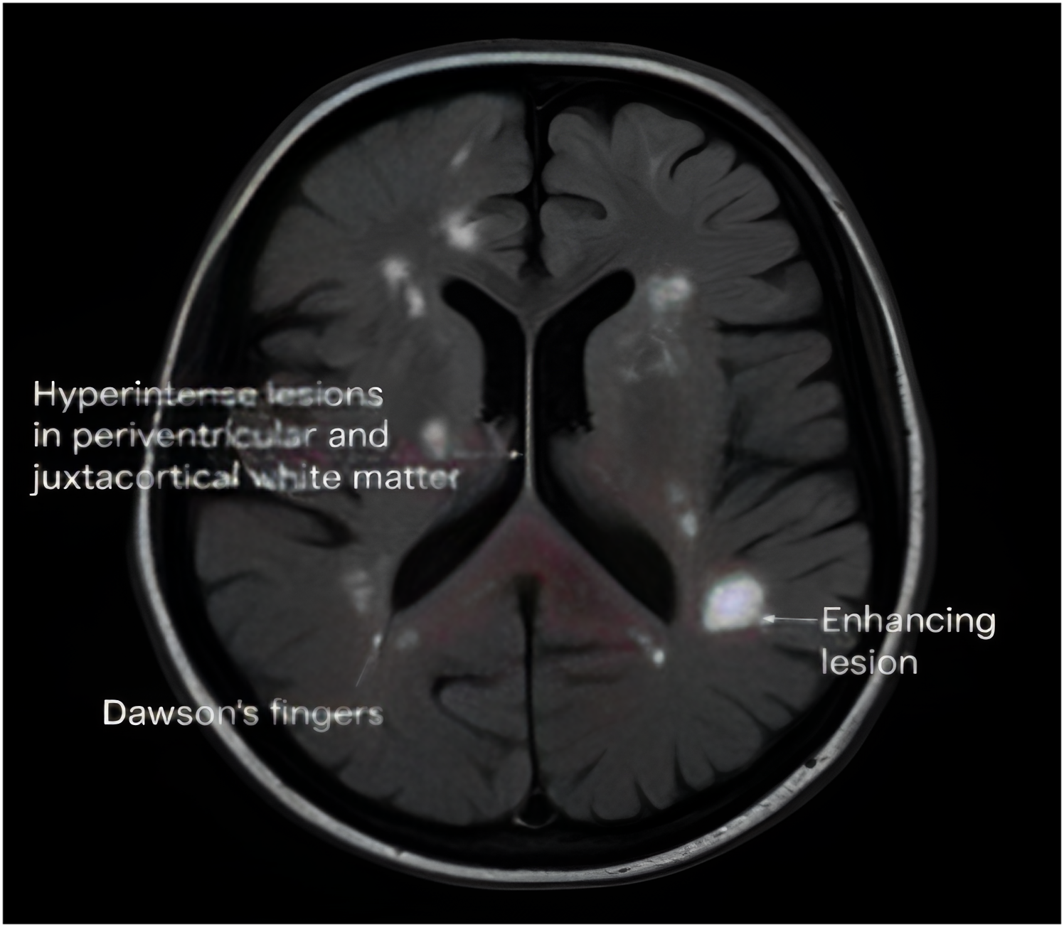 MRI Detects Early Multiple Sclerosis in a Young Adult