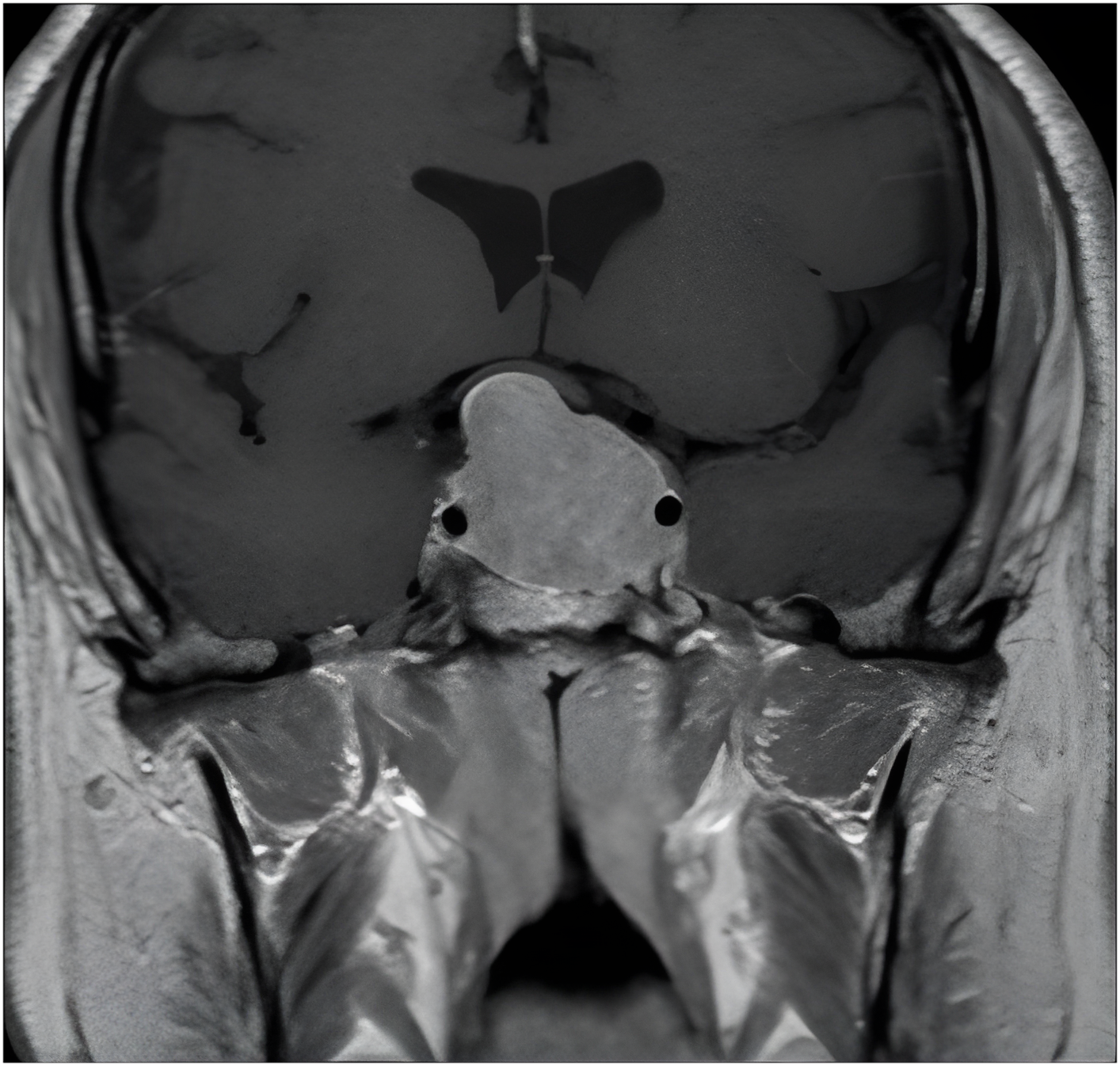 Pituitary macroadenoma | Radiology Reference Article ...